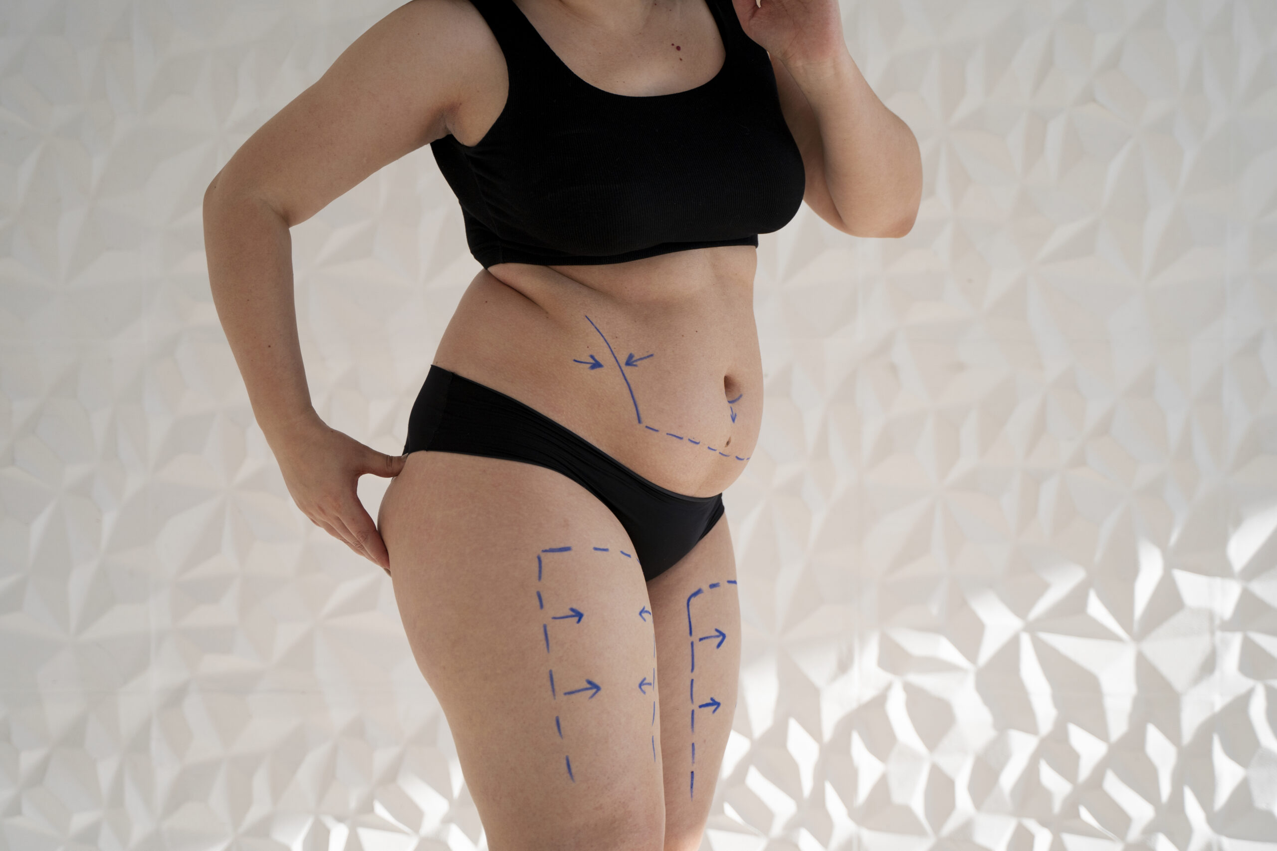 Procedures considered in a mommy makeover: tummy tuck, liposuction, breast lift and breast volume surgery